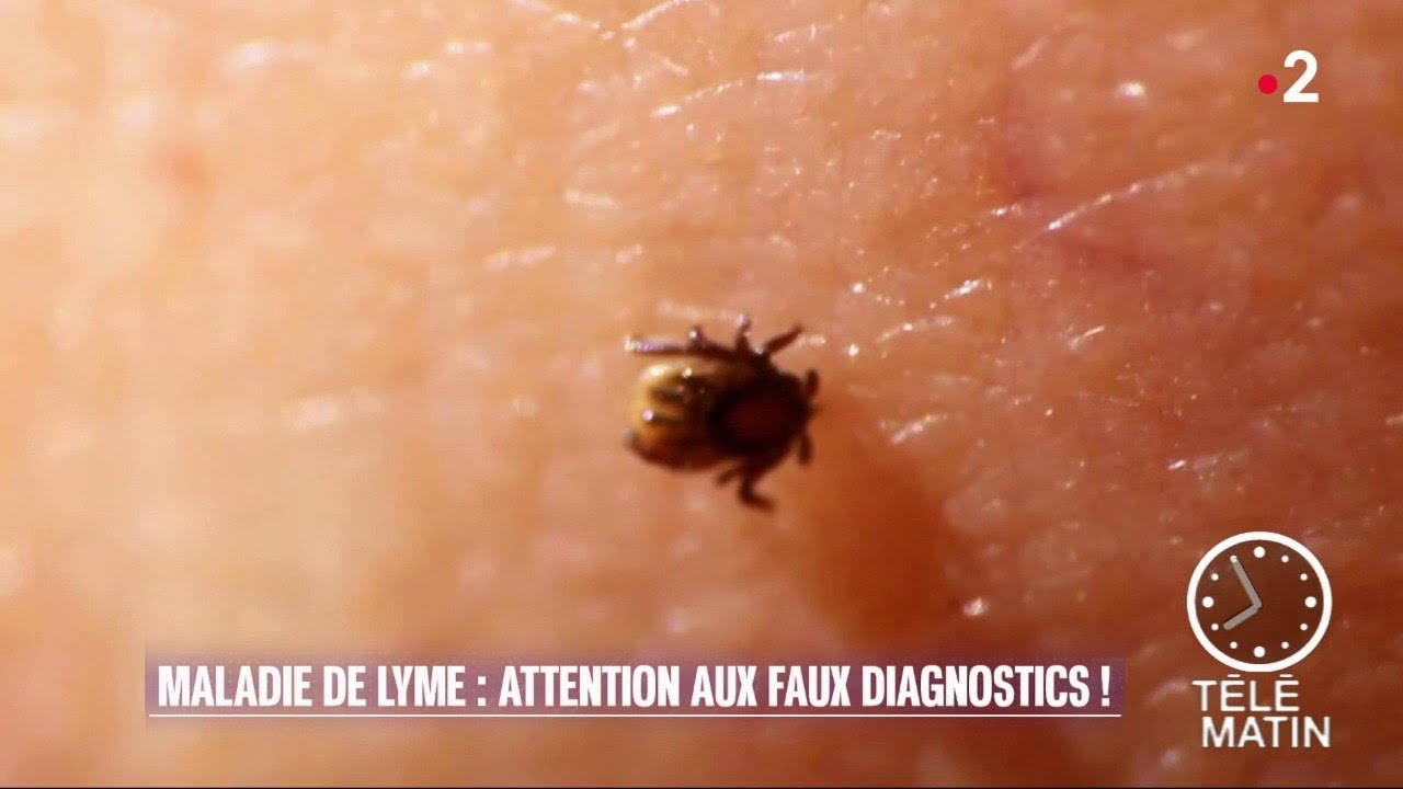 Santé - Maladie de Lyme, trop de faux diagnostics