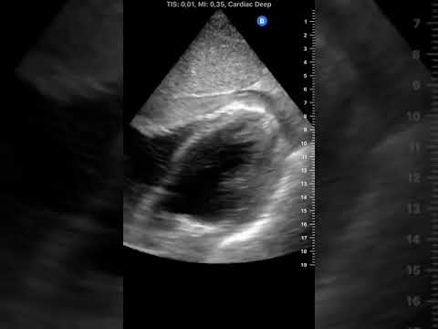 Cardiac Clot after