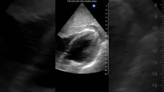 Cardiac Clot after Stab Wound | Clinical Image