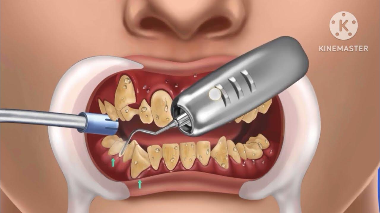 dental-implants-dental-implants-australia-all-on-4-dental-implants