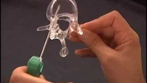 Video 2. Transpedicular lumbar