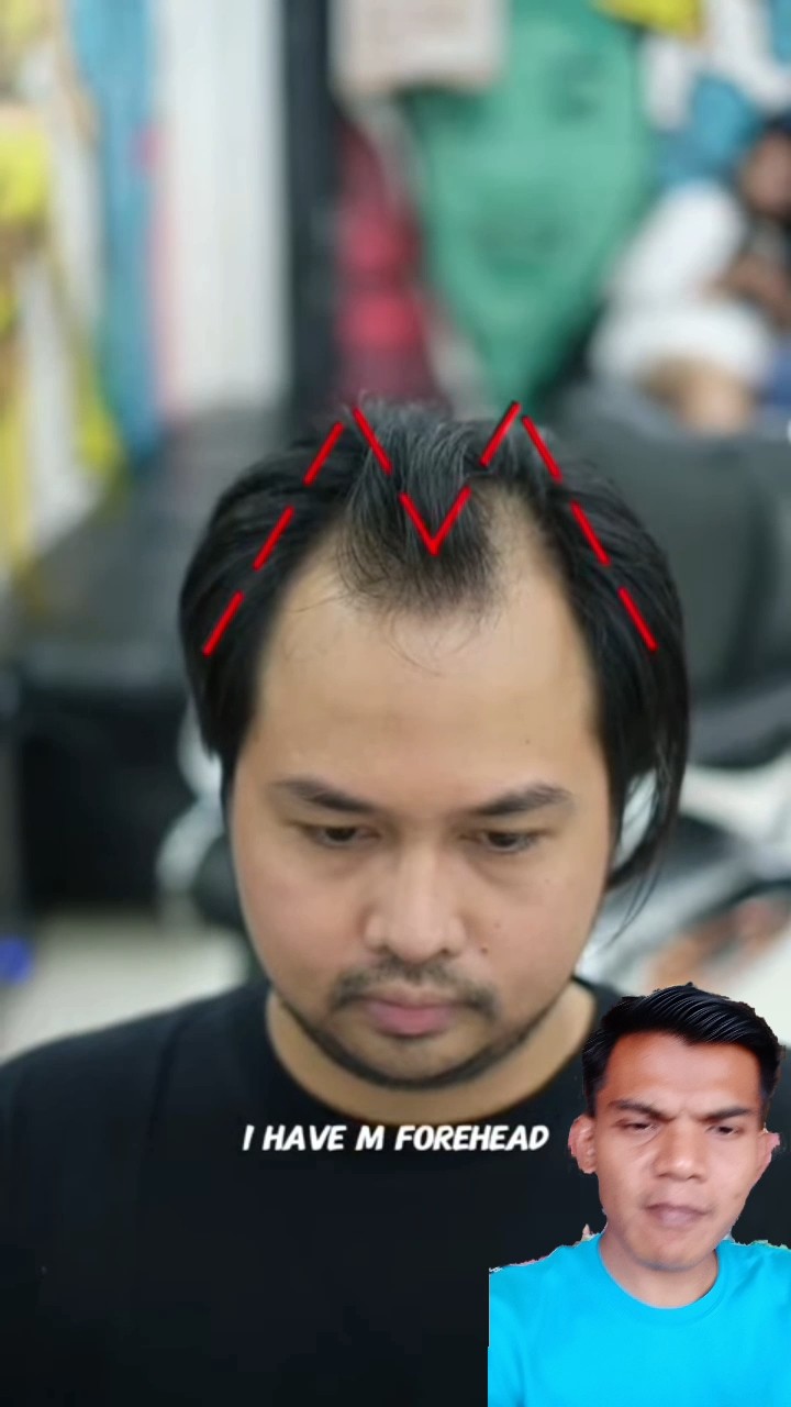 The M-Shaped Hairline: Understanding, Accepting, and Managing a Unique Feature