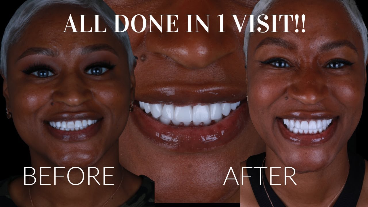 VENEERS: FROM COMPOSITE TO PORCELAIN  ALL IN SAME VISIT | SMILES BY DR. PRICE