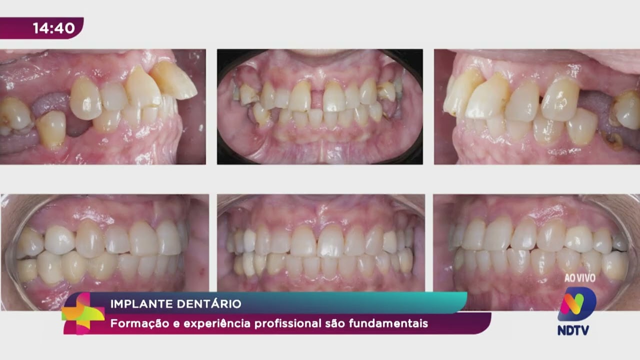 Implante dentário: formação e experiência profissional são fundamentais