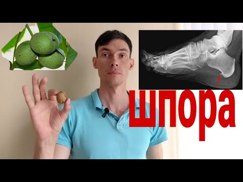 Что делать при пяточной шпоре в домашних условиях