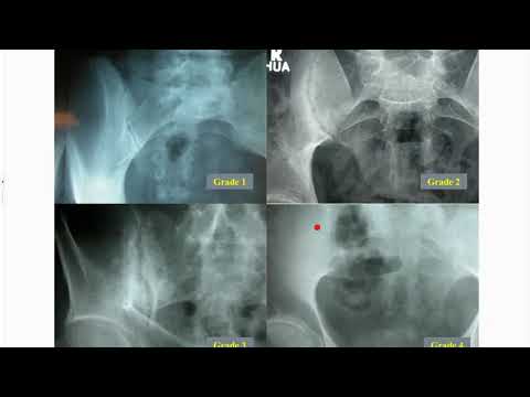 Video: MRI Dan X-ray Pada Spondyloarthritis Aksial: Hubungan Antara Perubahan Inflamasi Dan Struktural