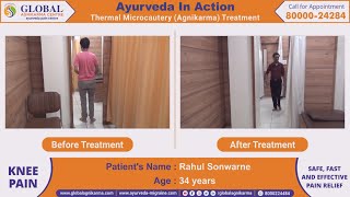 Ayurveda Treatment for Knee Pain, Osteoarthritis | Thermal Microcautery - Agnikarma