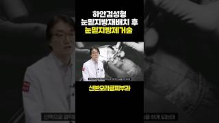 눈밑지방재배치 하안검성형 후 눈밑지방제거술 재수술을 위해 내원 하시는 경우 #눈밑지방#눈밑지방제거#눈밑지방재배치