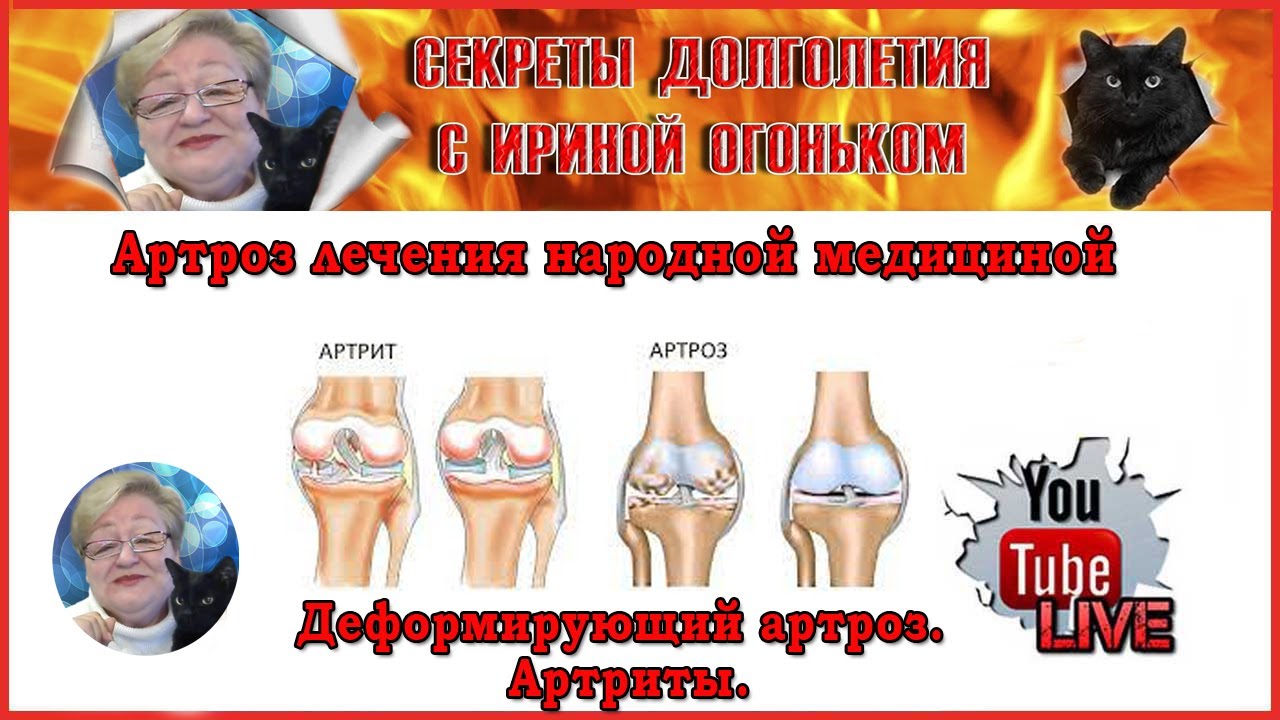 Боль в суставах. Артриты артрозы лечение народными средствами. Народные ...