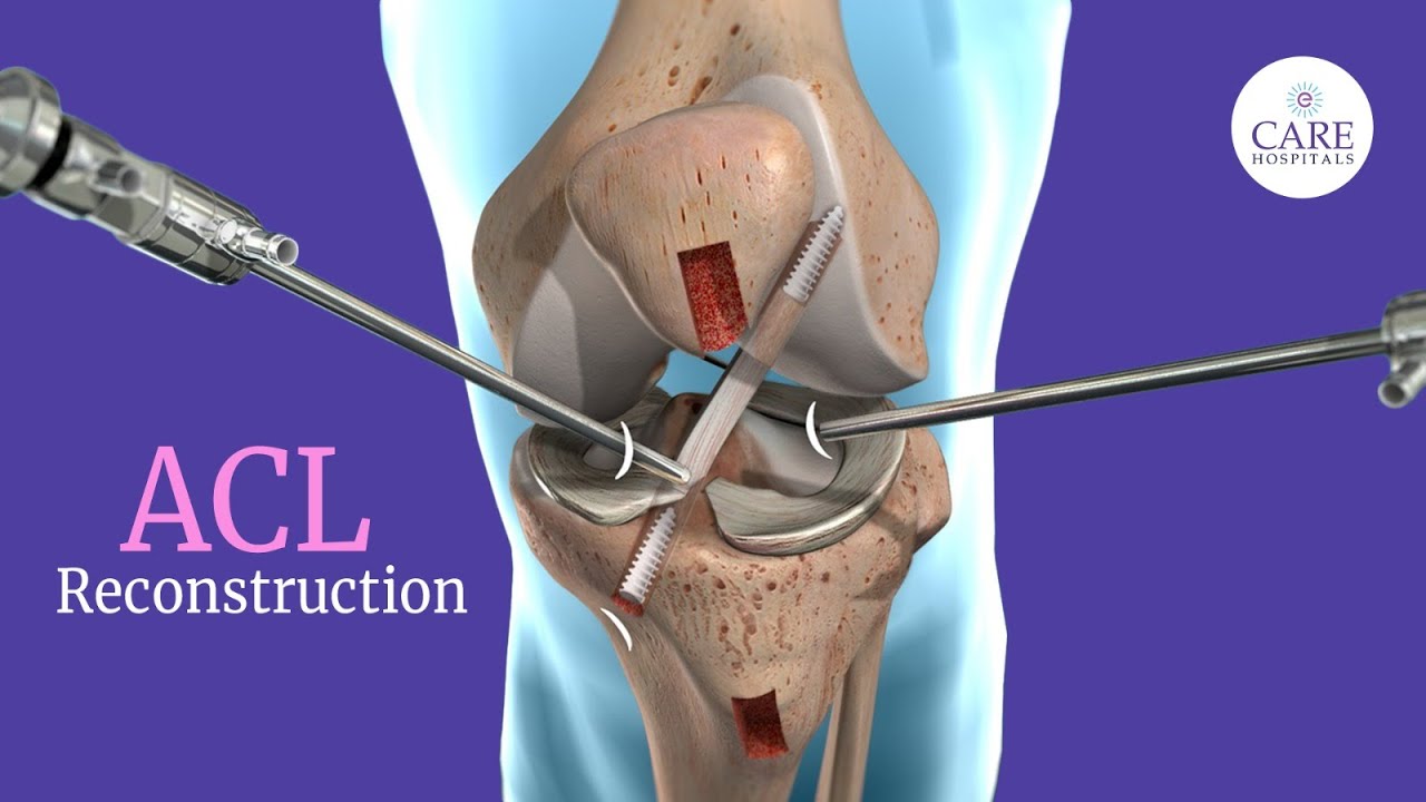 What is ACL Reconstruction and How it is Done? | CARE Hospitals - YouTube