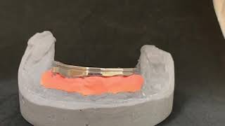 Implant bar over denture