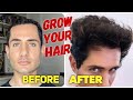 1 Year Hair Transplant Results | Istanbul Turkey | Before and After