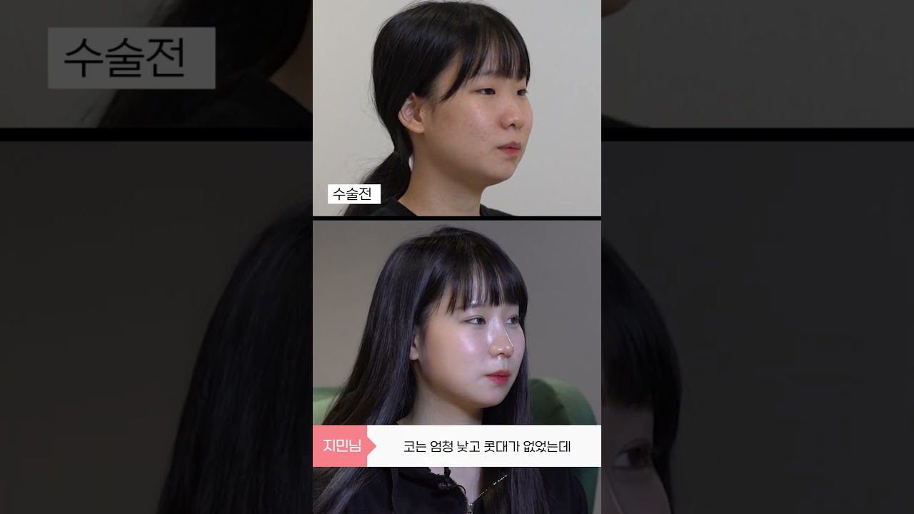 [A-TOP 整形外科] 現在要入學囉~做了眼部整形、鼻部整形、臉部抽脂手術！#shorts