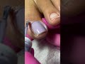Total Pedicure Glow-Up 🦶✨ #toenailtransformation#pedicuretransformation#nailtransformation
