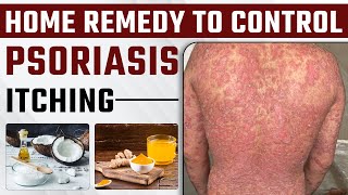 How to Get Relief From Psoriasis Itching | Tips to Control Psoriasis Naturally | Dr Megha Chaturvedi