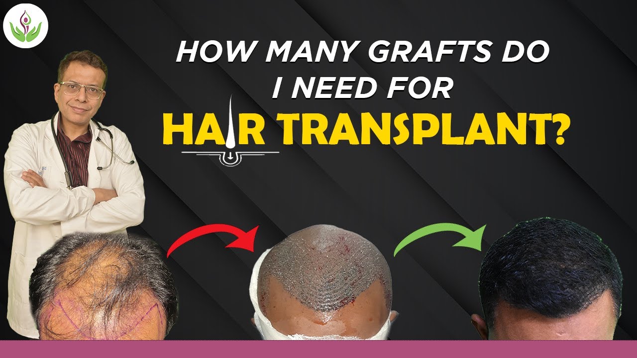 How Many Grafts Need Calculator For Hair Transplant? | Care Well Medical Centre