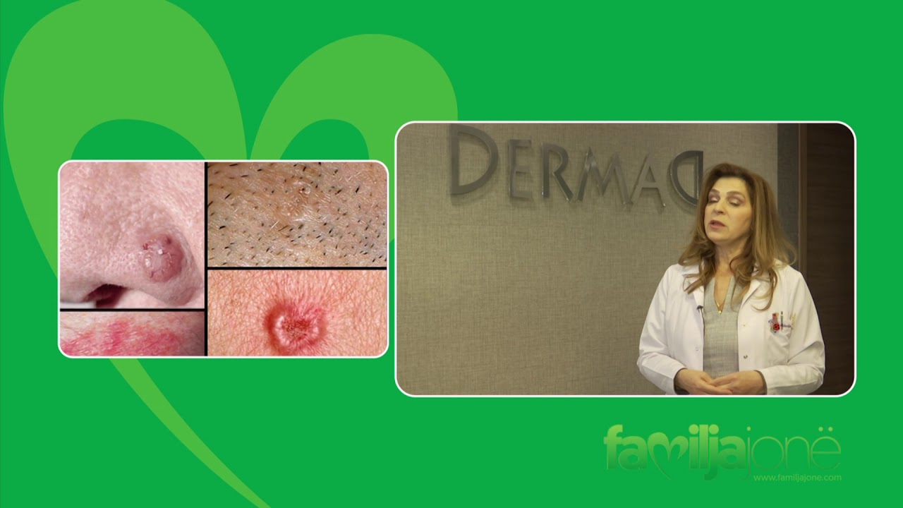 Shkëndije Dobruna - Dermatologe - Çka është Melanoma ?