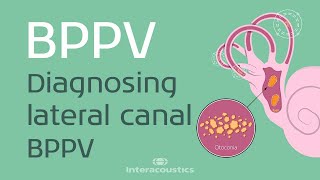 How to Diagnose Lateral Canal BPPV