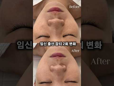기미 잡티 2회 임상 맞아? (고정 댓글)