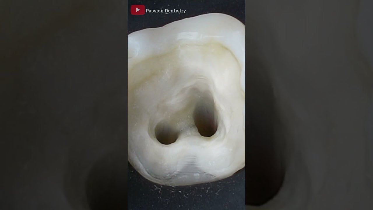Accessing The Root Canals Teeths