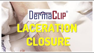 DermaClip Wound Closure Demonstration