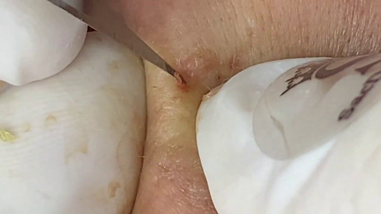 Blackhead Extract | Nặn Mụn Đầu Đen Chân Sâu  - SacDepSpa#200