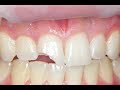 Fix a Chipped or broken tooth at home, cheap!