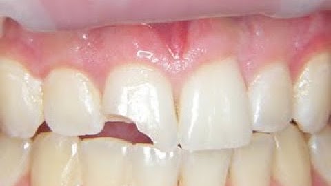 Fix a Chipped or broken tooth at home, cheap!