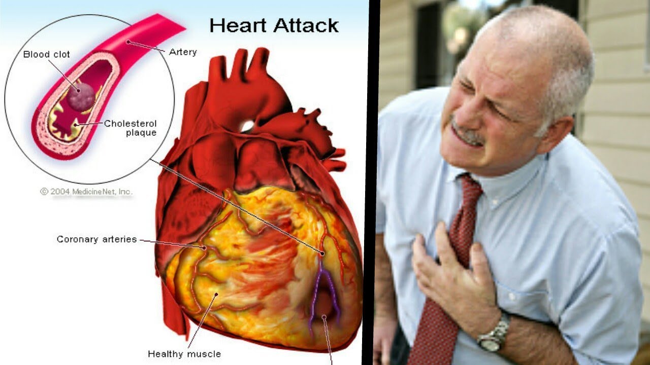 Msheartattack Hot