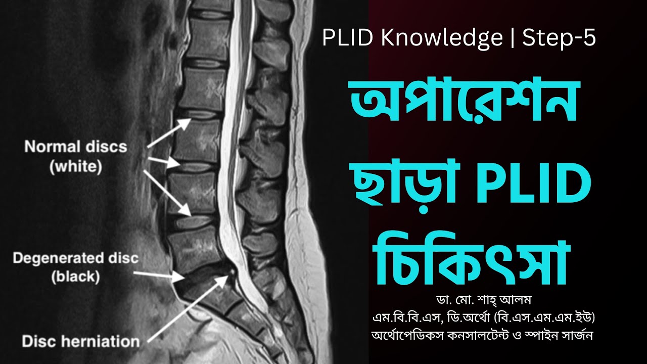 PLID 5 | অপারেশন ছাড়া PLID চিকিৎসা | PLID Without Surgery | Doctor Shah Alam