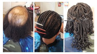 Alopecia | Another Technique for Crochet Braids!