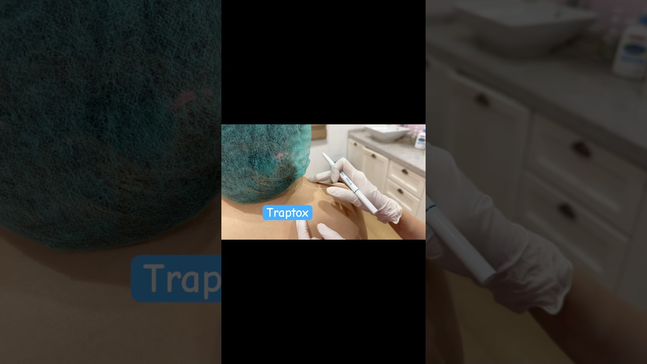 Trapezius Botox 💉 