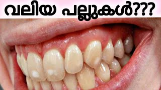 big front teeth / braces / pallil kambi idunnath / pallil kambi / big to small teeth / dr athira