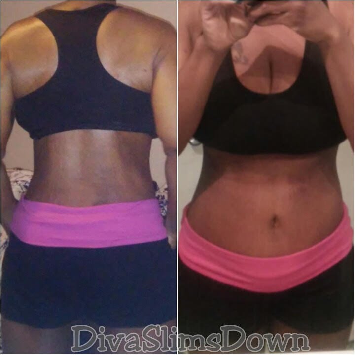 2 Weeks Post Op Reverse Tummy Tuck and Bra Line Back Lift YouTube