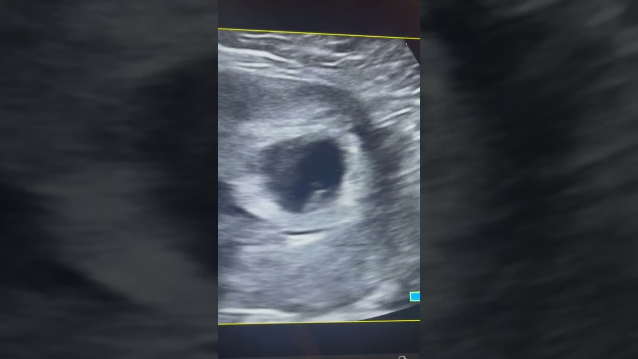 5 week ultrasound with a strong heartbeat