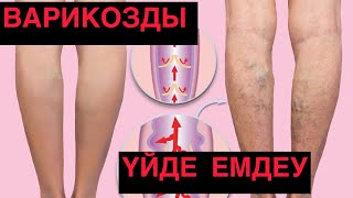 Варикозды Үйде Емдеу Тәсілдері. Densaulyq Arnasy
