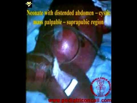 Video: Synechiae Pada Anak Perempuan - Synechiae Labia, Vulva, Vagina