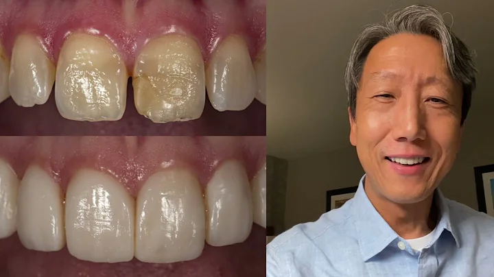 Becoming Proficient at Composite Bonding with Jero...