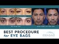 Best Procedures for Treating Puffy Under Eye Bags and Adjacent Hollowness