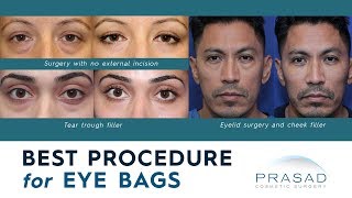 Best Procedures for Treating Puffy Under Eye Bags and Adjacent Hollowness