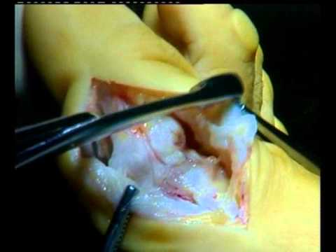 Cirugia de juanetes con tornillos