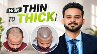 Hair Transplant in Saharanpur (HX-SABH) | Best Results &amp; Cost of Hair Transplant in Saharanpur