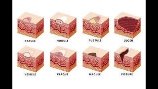 Macule, Patch, Papule, Plaque, Nodule, Tumor Skin Conditions
