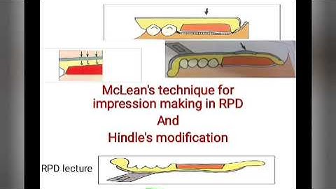 McLean technique||hindle