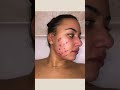 12 Weeks Differin cream 0.1%  Doxycycline 100mg for hormonal acne results #shorts