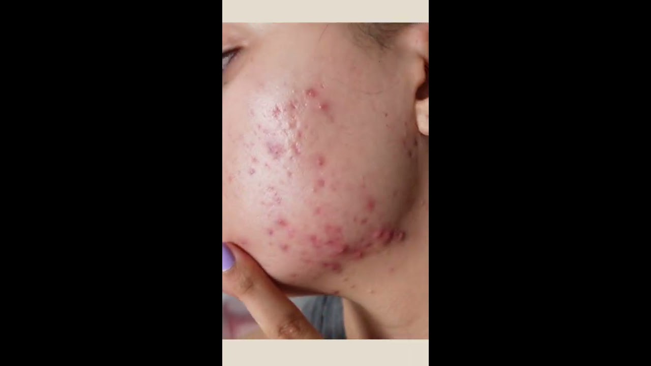 12 Weeks Differin Cream 0 1 Doxycycline 100mg For Hormonal Acne Results Shorts