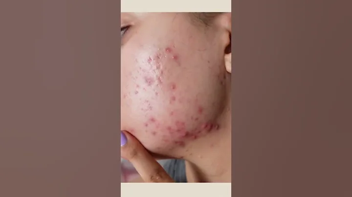 12 Weeks Differin cream 0.1%  Doxycycline 100mg for hormonal acne results #shorts