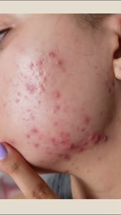 12 Weeks Differin cream 0.1%  Doxycycline 100mg for hormonal acne results #shorts
