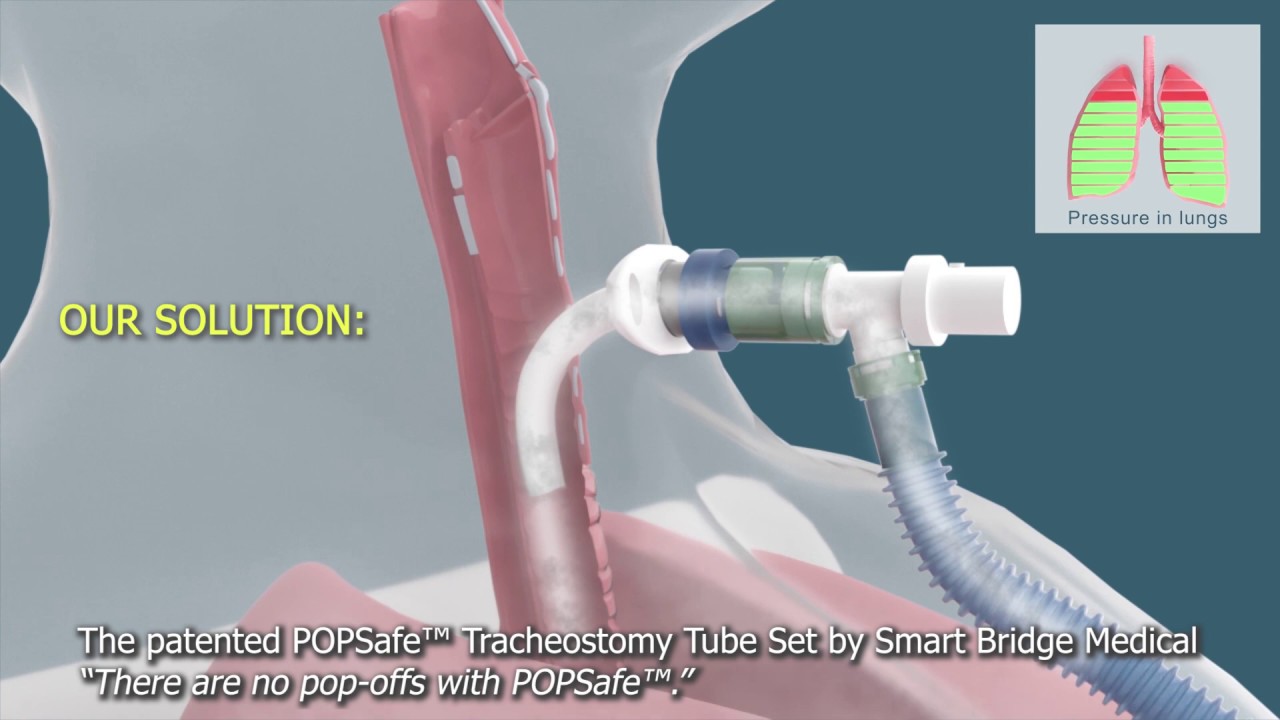 The patented POPSafe™ Tracheostomy Tube Set by Smart Bridge Medical - 3D  Medical Animation - YouTube