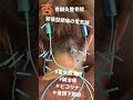 筋緊張型の頭痛の電気鍼